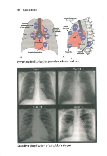 Sarcoidosis
