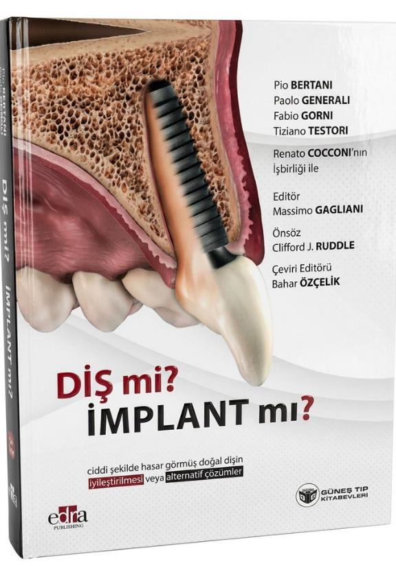 Diş mi İmplant mı (Doğal Dişin Korunması veya İmplant Çözümleri Üzerine Kapsamlı Rehber)