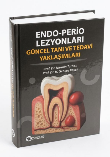 Endo - Perio Lezyonları Güncel Tanı ve Tedavi Yakl