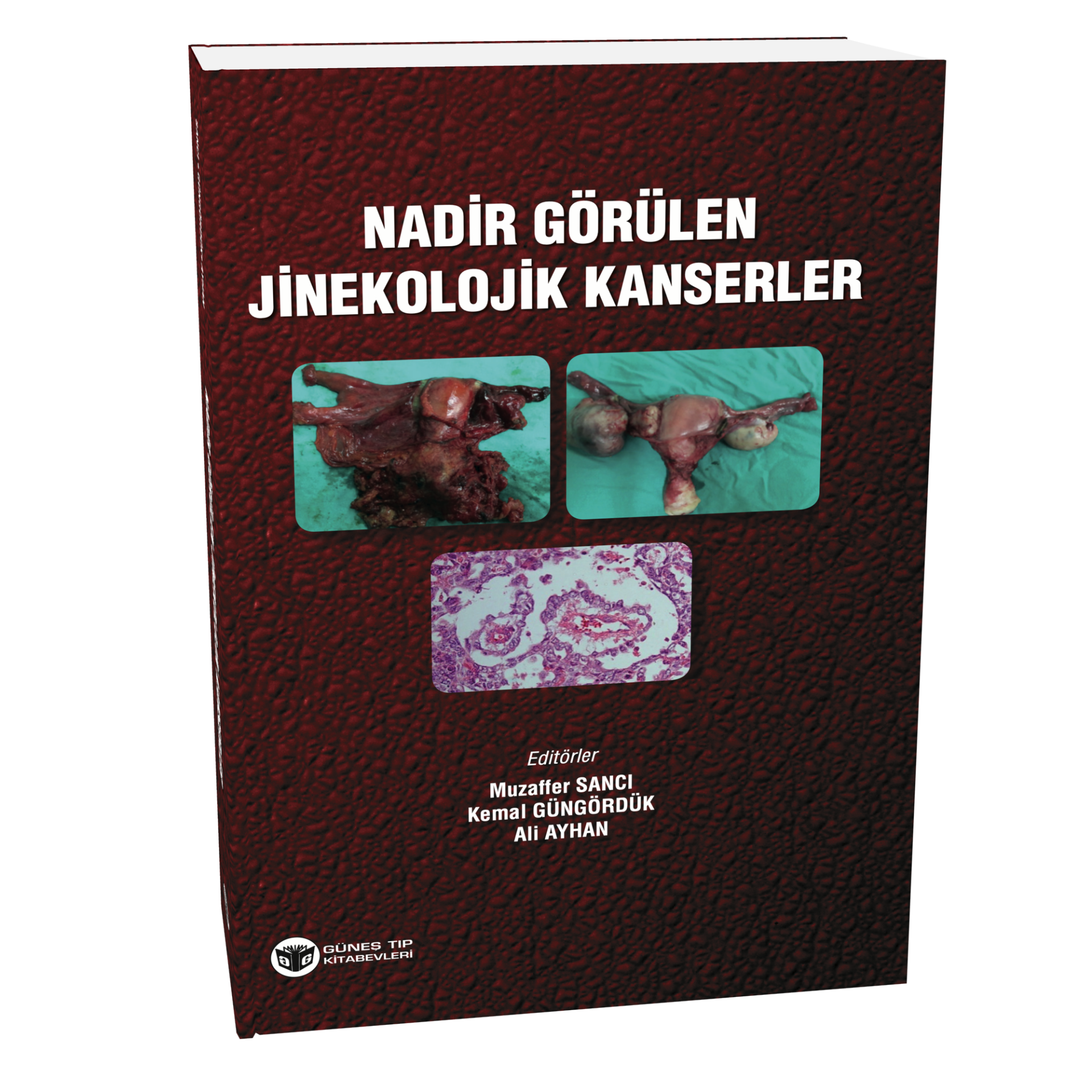 Nadir Görülen Jinekolojik Kanserler