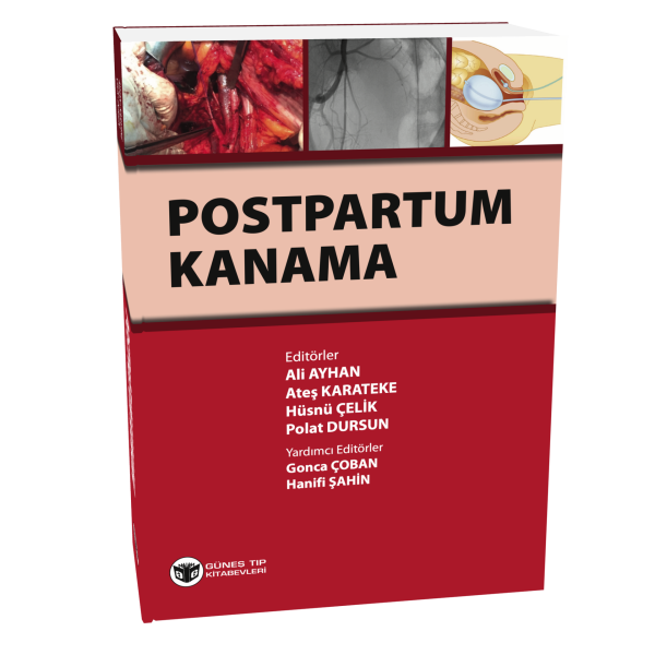 Postpartum Kanama